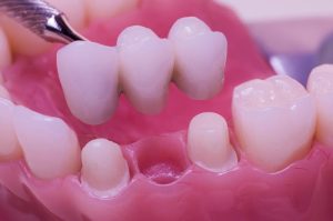Same-Day Dental Bridges