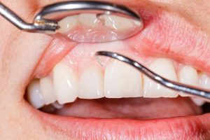 Gum Disease Treatment